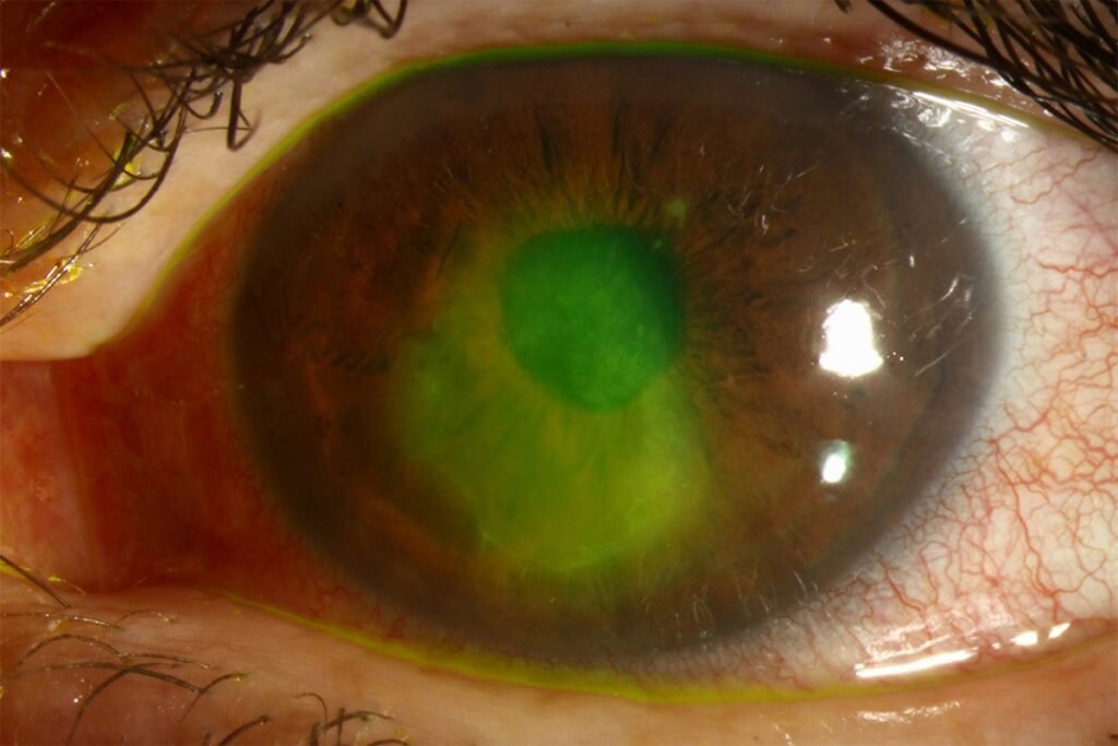 persistant-epithelial-defects