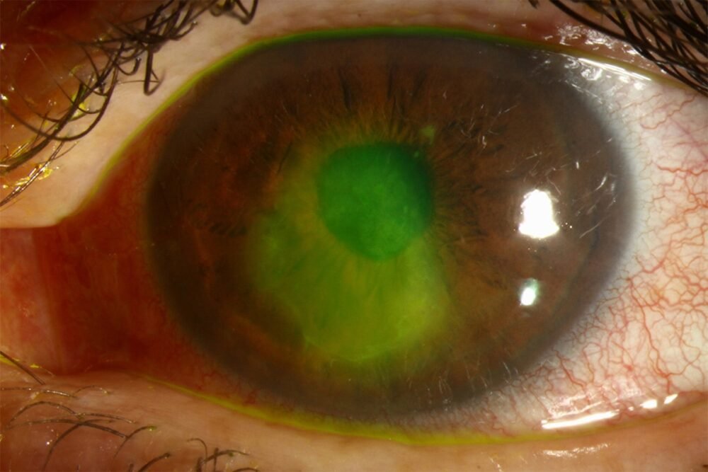 persistant-epithelial-defects